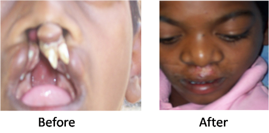 Speciality Camp-Plastic Surgery-This boy could not talk properly since birth, could not eat properly