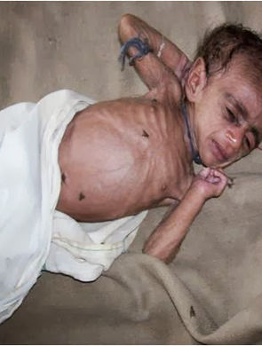 Severely Malnourished child