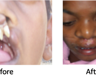Speciality Camp-Plastic Surgery