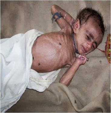 Severely Malnourished child