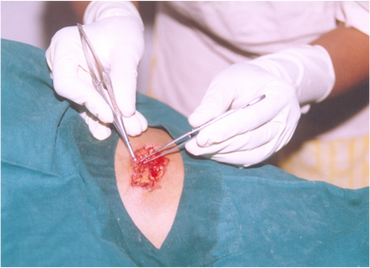 Bear bite is not uncommon in Melghat. One of such patients undergoing surgery